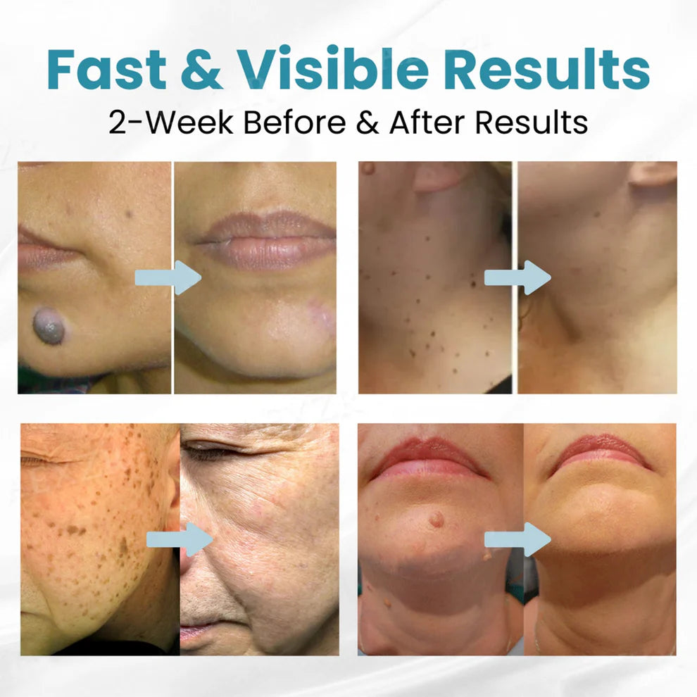 LOVILDS™ Bolígrafo Láser para Eliminación No Invasiva de Lunares y Verrugas